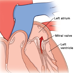 What happens to the heart during mitral valve prolapse