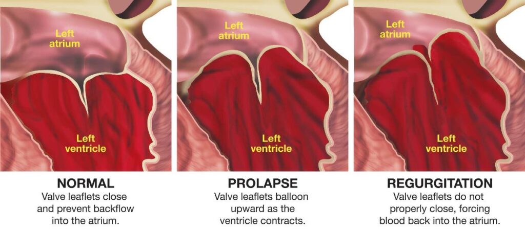 What is mitral valve prolapse