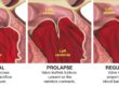 What is mitral valve prolapse