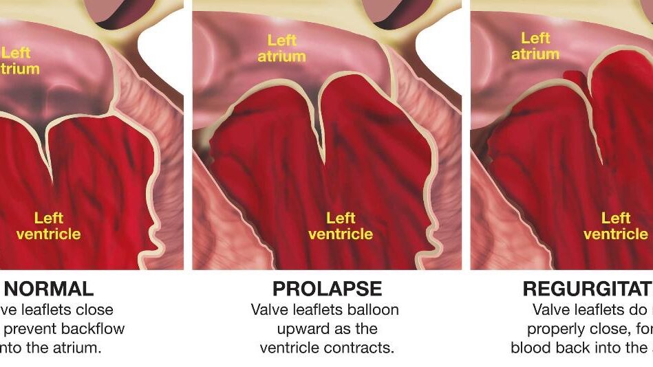 What is mitral valve prolapse