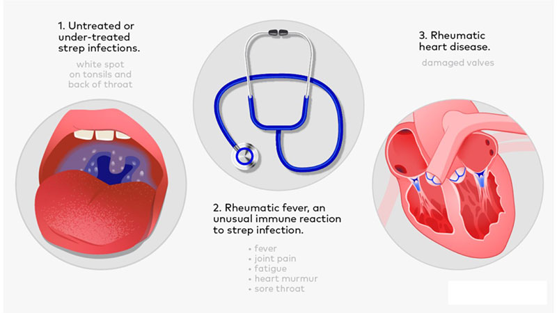 Rheumatic fever2