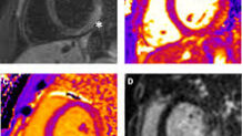 Acute Myocarditis in children assessed in London by Dr. Alessandro Giardini Acute Myocarditis in children assessed in London by Dr. Alessandro Giardini
