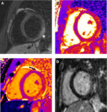 Acute Myocarditis in children assessed in London by Dr. Alessandro Giardini