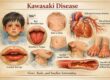 Kawasaki disease symptoms and complications diagram