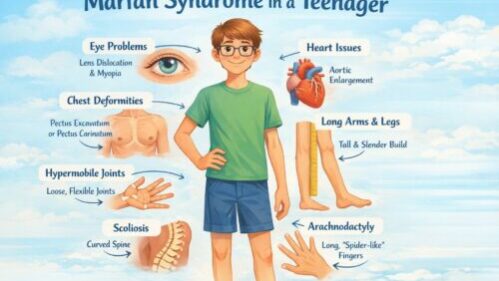 Marfan Syndrome educational illustration Marfan Syndrome educational illustration