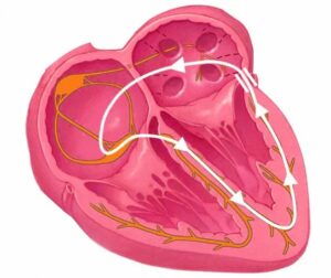 Wolff Parkinson White image of the accessory pathway in children
