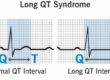 long qt syndrome ECG