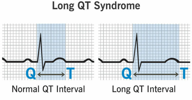 long qt syndrome ECG