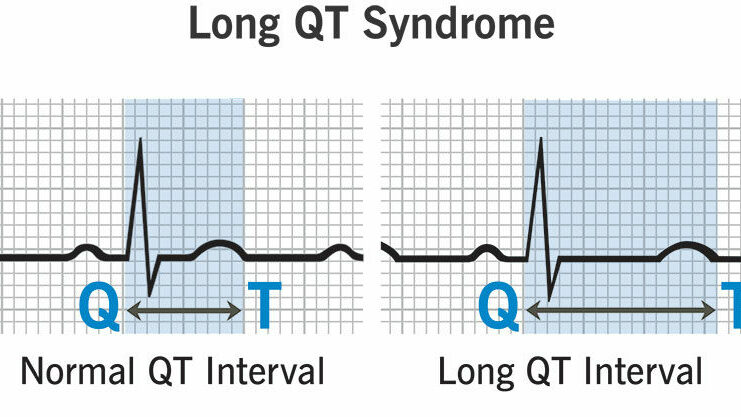 long qt syndrome ECG long qt syndrome ECG