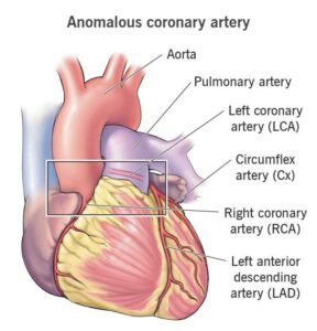 Anomalous coronary artery children 1 softened