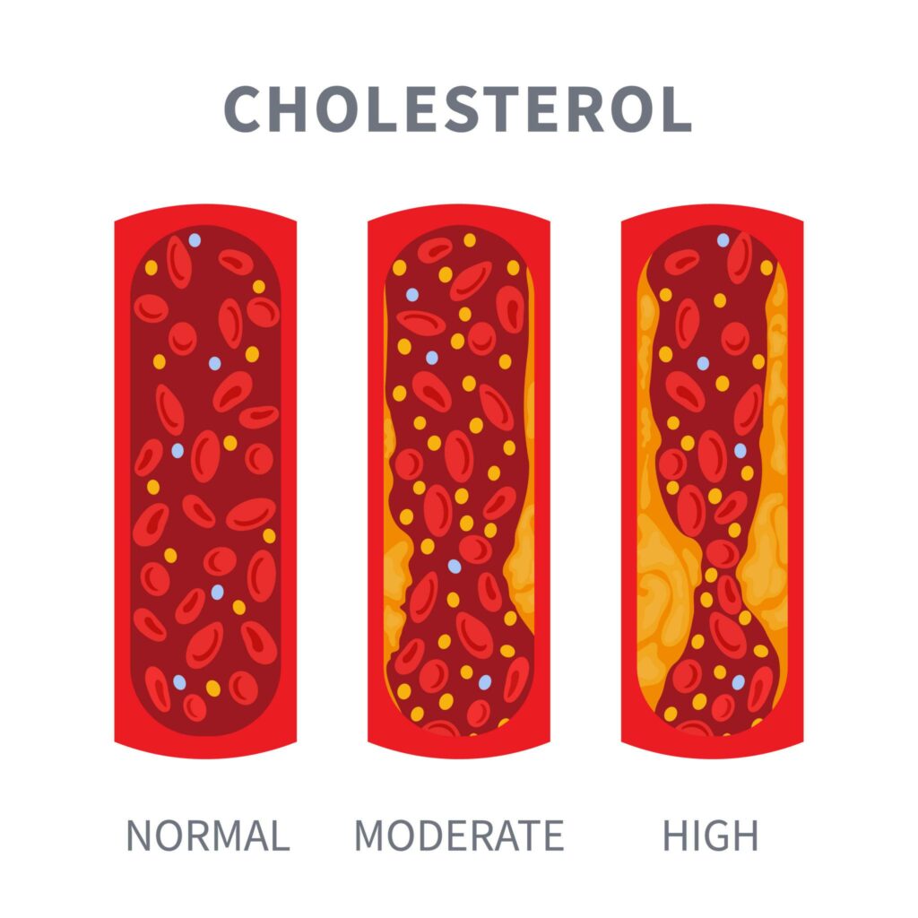 Cholesterol and the efect on the heart