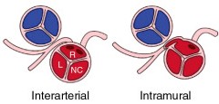 Coronary artery anomalies 1