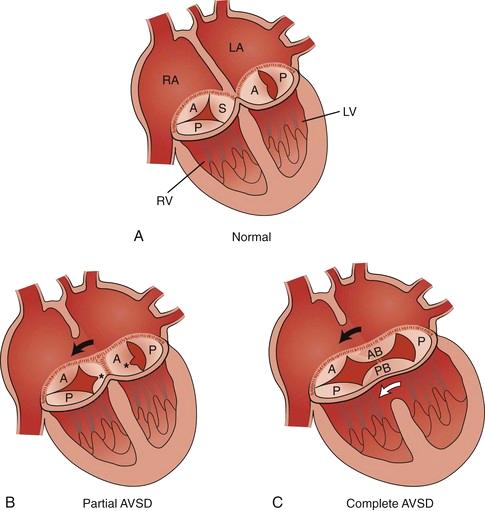 Partial and complete AVSD in children