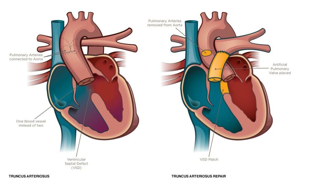 Truncus arteriosus repair
