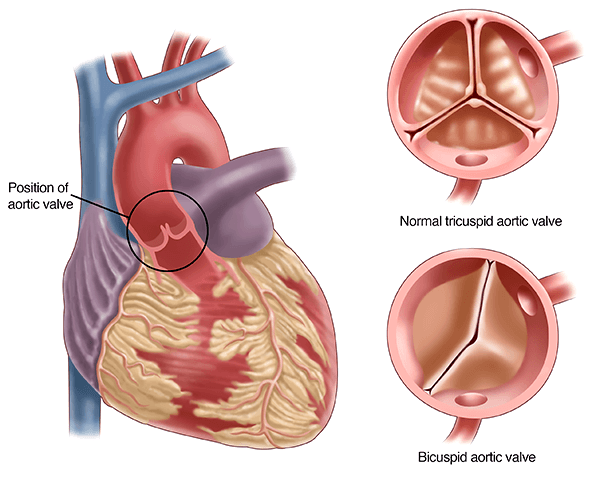 bicuspid aortic valve children bicuspid aortic valve children London