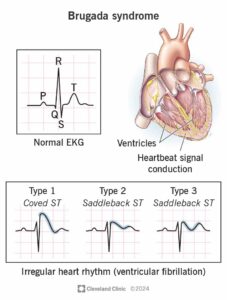 brugada syndrome in children London