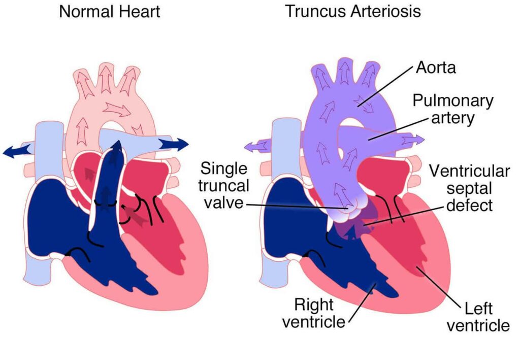 truncus arteriousus in children and normal heart